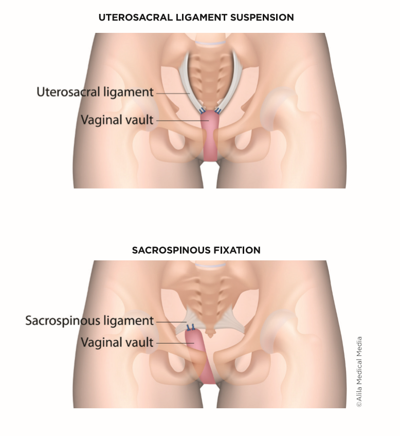 Uterosacral Ligament Suspension & Sacrospinous Fixation