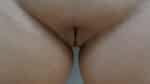Labia Minoraplasty