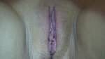 Labia Minoraplasty