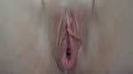 Labia Minoraplasty
