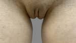Labia Minoraplasty
