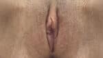 Labia Minoraplasty