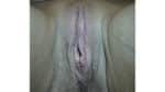 Labia Majoraplasty