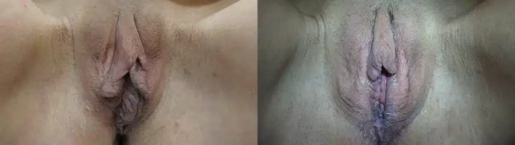 labia minoraplasty before and after photo by urogynecology of kansas city mo