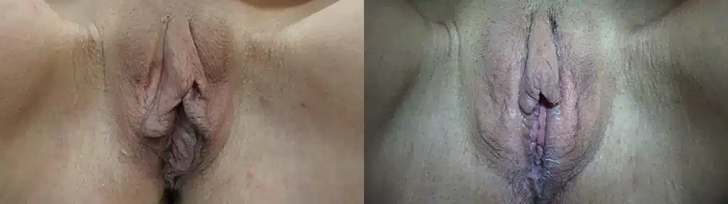 clitoral hood reduction before and after photo by urogynecology of kansas city mo