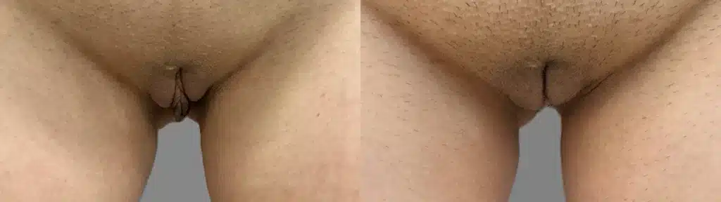 clitoral hood reduction before and after photo by urogynecology of kansas city mo