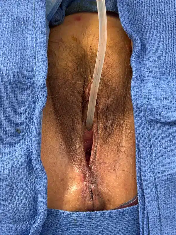 After partial colpocleisis Photo
