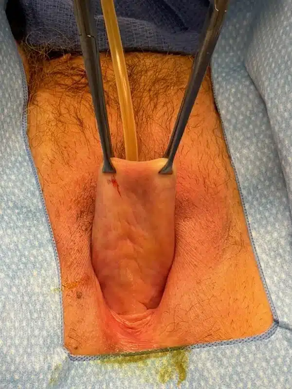 Before complete colpocleisis Image #2