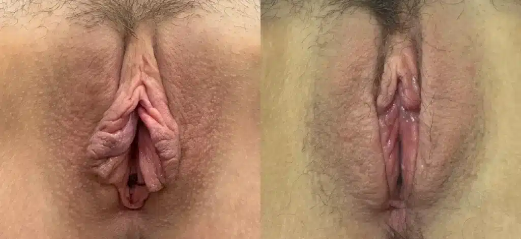 front view labia minora clitoral hood reduction before and after photo by dr nosti