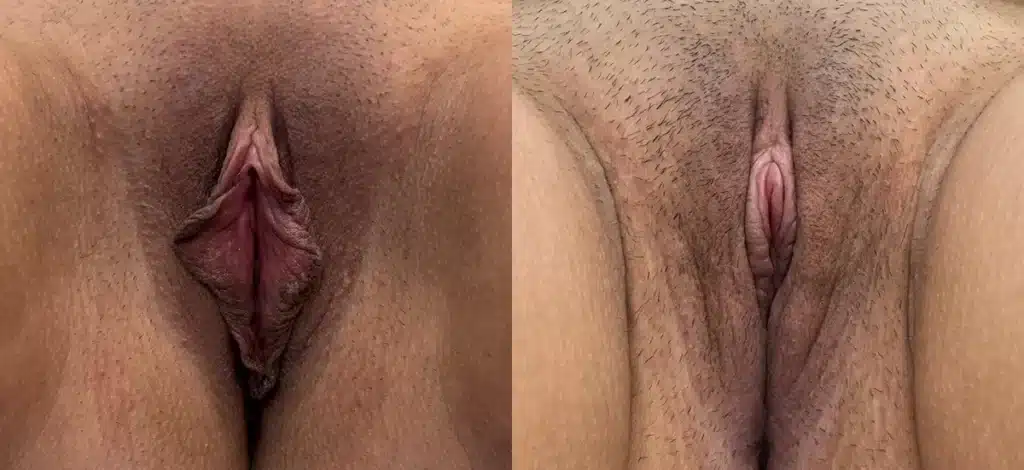 front view labia minora perineoplasty clitoral hood reduction before and after photo by dr nosti