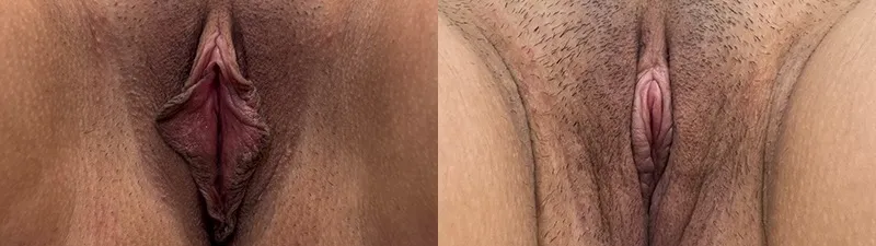 front view labia minora perineoplasty clitoral hood reduction before and after photo by dr nosti