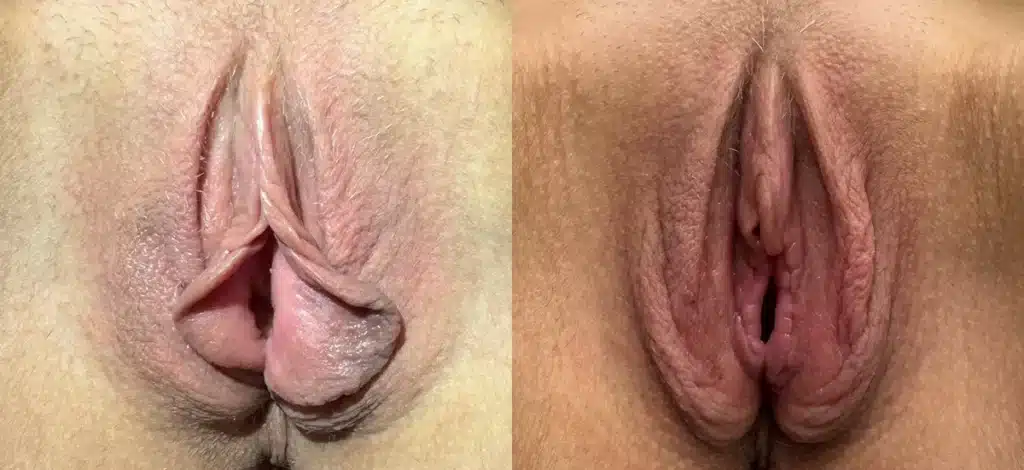 front view labia minoraplasty before and after photo by dr nosti