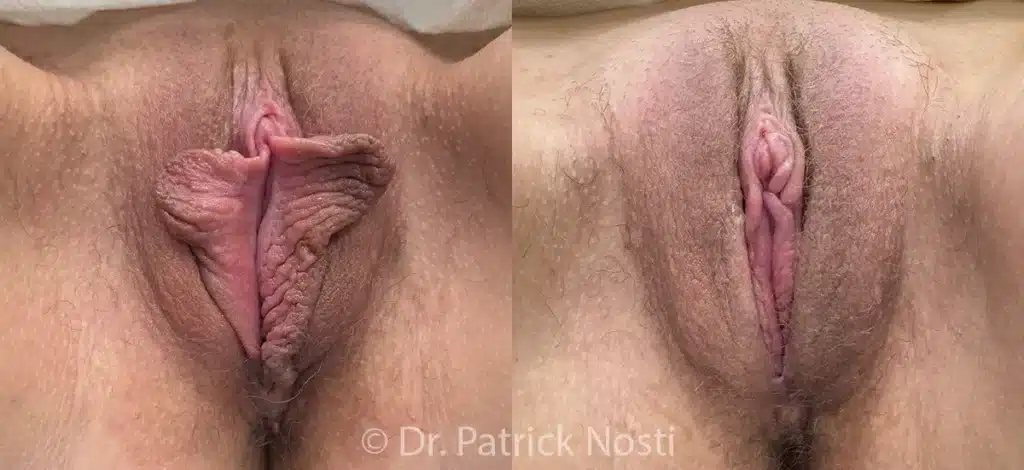 front view labia minoraplasty with perineoplasty before and after photo by dr nosti
