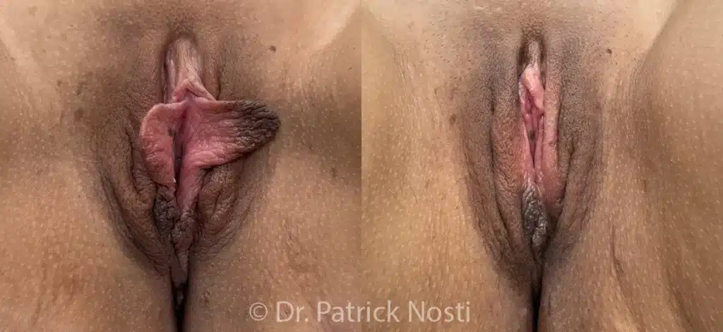 front view labia minoraplasty before and after photo by dr nosti