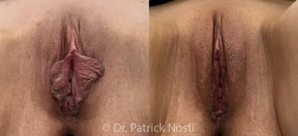 front view labia minoraplasty before and after photo by dr nosti
