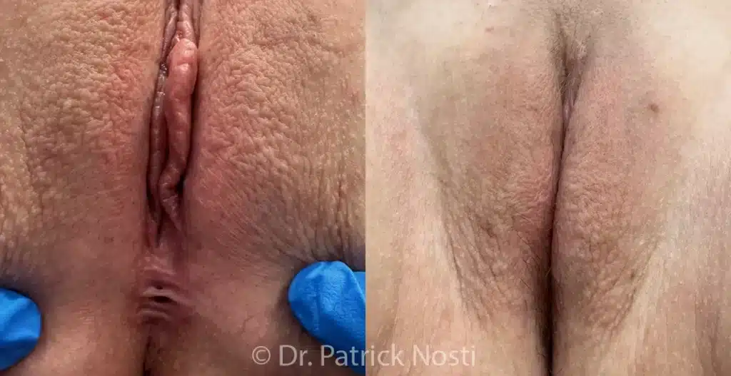 supine view revision surgery before and after photo by dr nosti