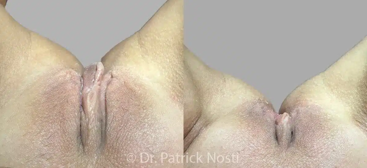 cephalad view labia minoraplasty, perineoplasty & removal anal skin tags before and after photo by dr nosti