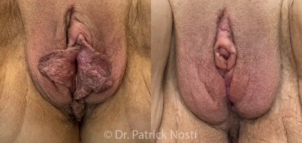 front view labia minoraplasty before and after photo by dr nosti