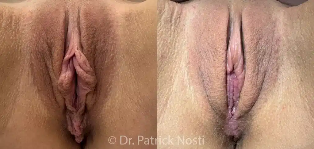 front view labia minoraplasty before and after photo by dr nosti