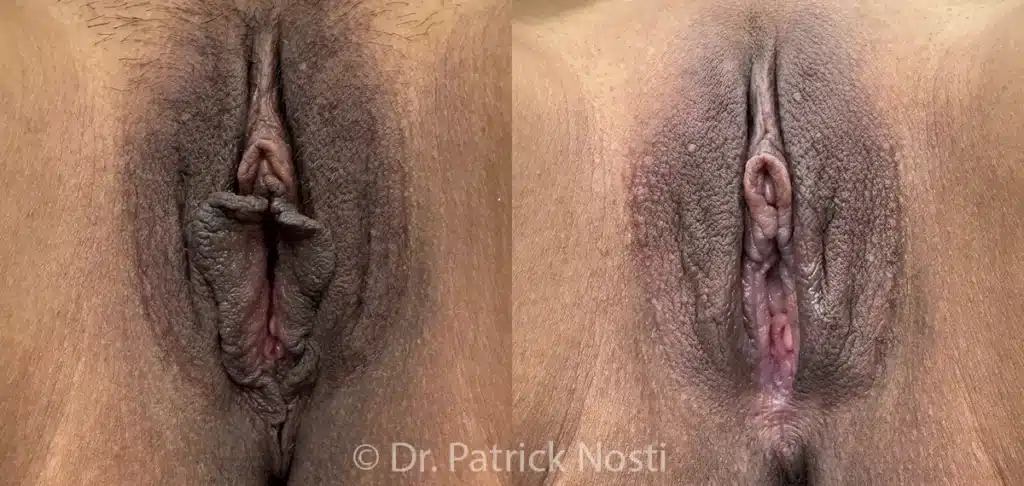 front view labia minoraplasty with perineoplasty before and after photo by dr nosti