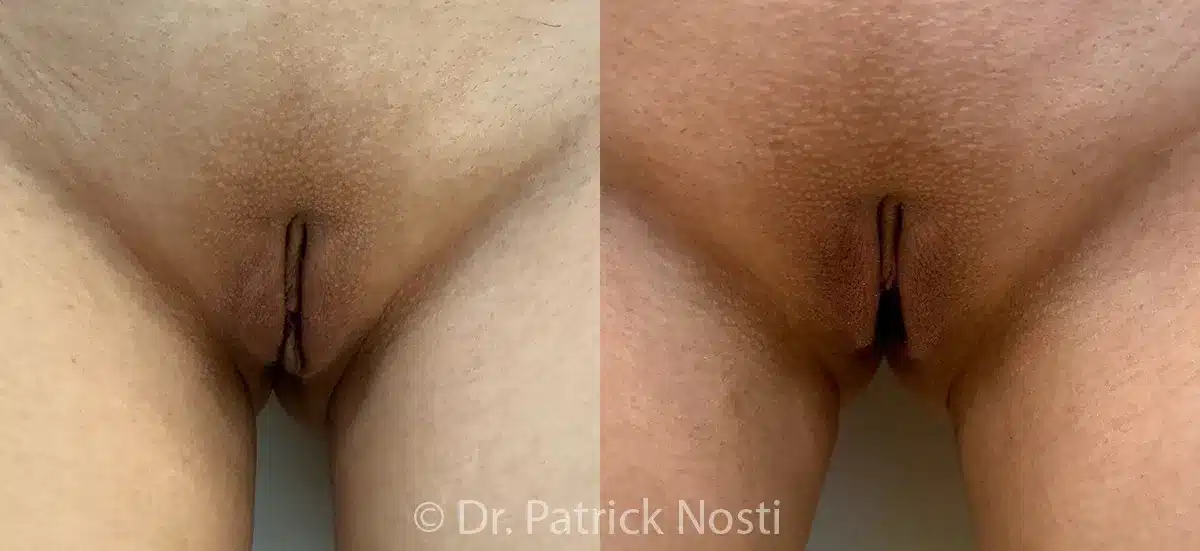 standing view labia minoraplasty, perineoplasty & removal anal skin tags before and after photo by dr nosti