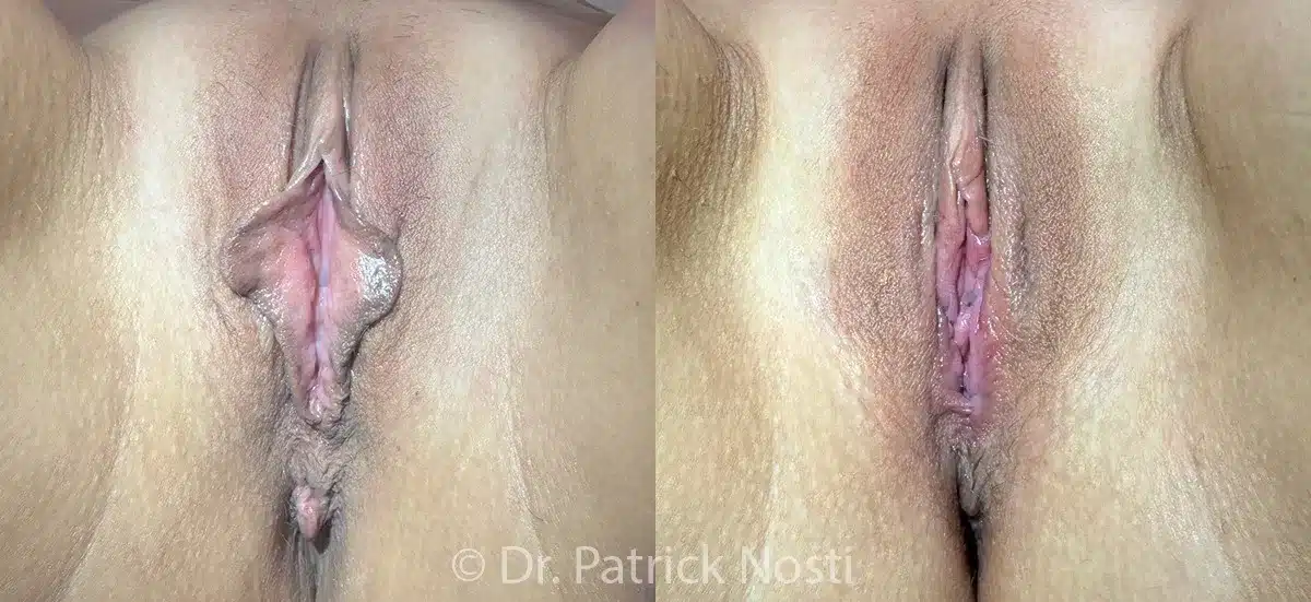 supine view labia minoraplasty, perineoplasty & removal anal skin tags before and after photo by dr nosti