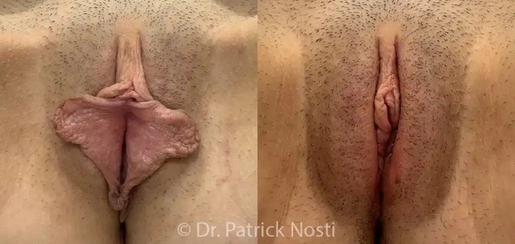 front view labia minoraplasty, clitoral hood reduction & perineoplasty before and after photo by dr nosti