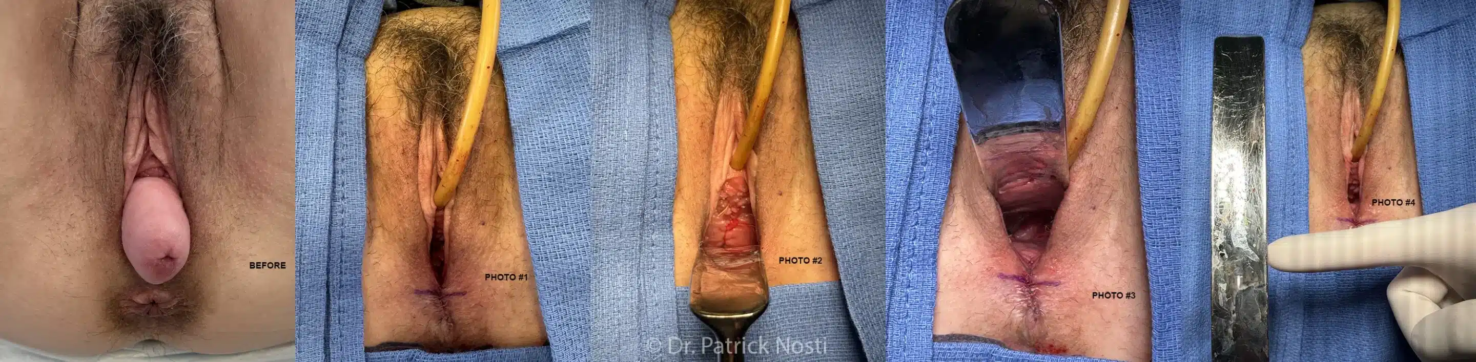 uterosacral suspension before and after photos by Dr. Nosti