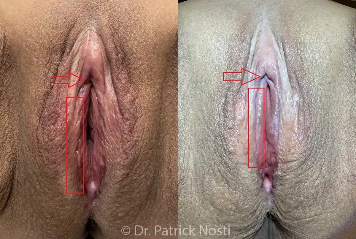 front view lichen sclerosus before and after photo by dr nosti